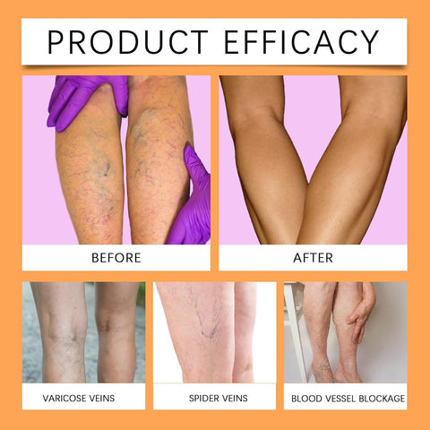 Turmeric Varicose Vein Relief Spray( BUY 1 GET 1 FREE )